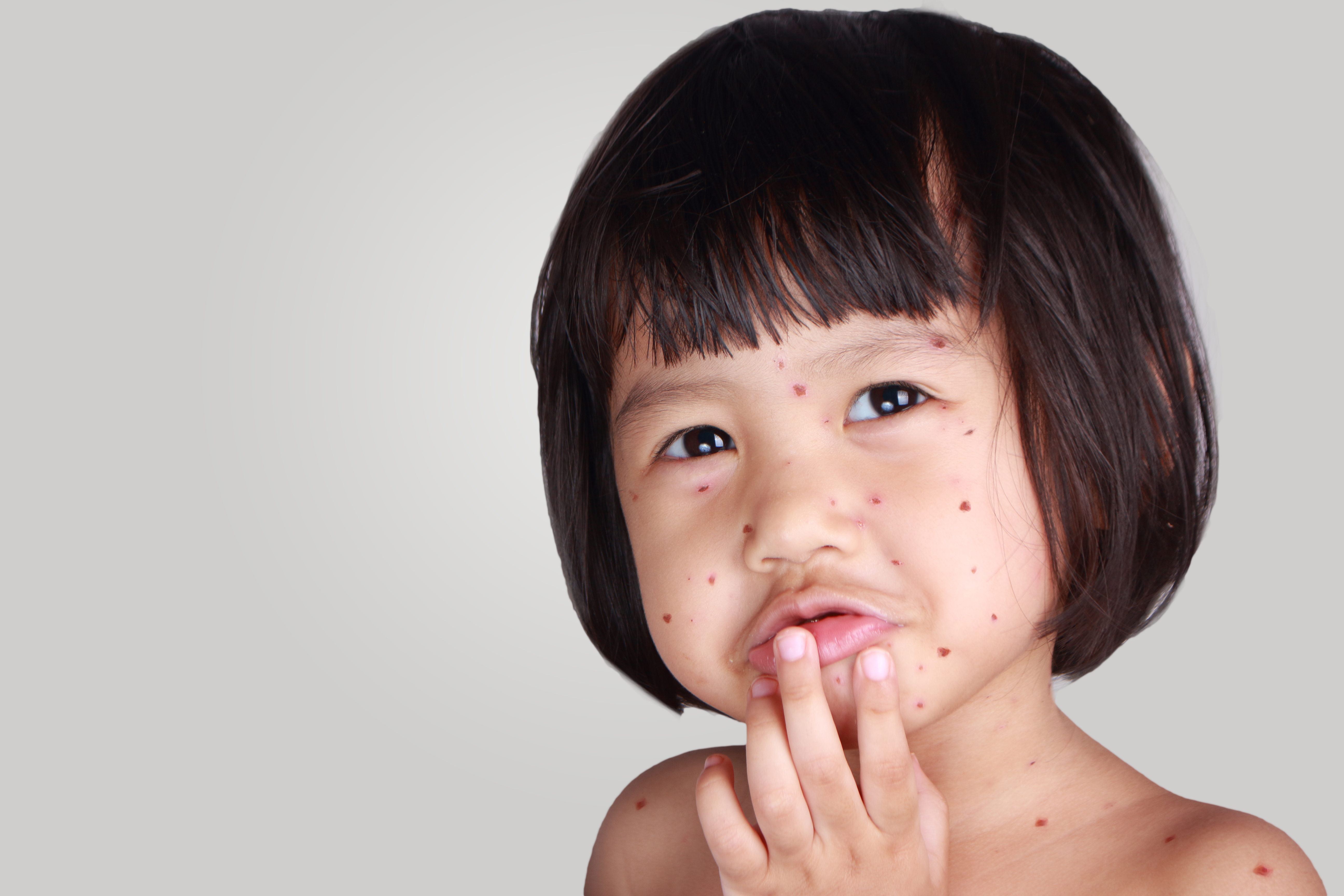 image of a child with chickenpox
